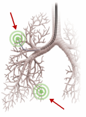 resp-pulmonary-nodule
