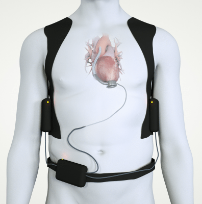 left ventricular assist device illustration