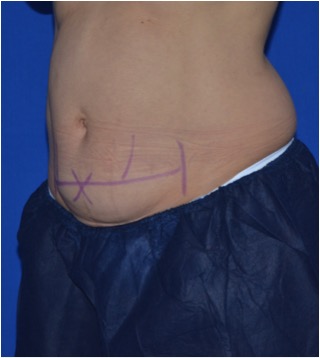 Abdomen before CoolSculpting