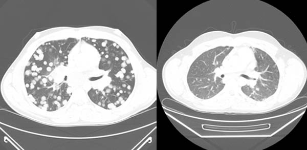 Two scans show Jeb Schroder's lungs before and after treatment. In one, there are a whole lot of white spots, which are tumors. In the other, you see his lungs, but no spots.