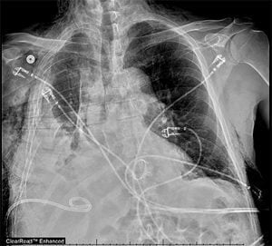 This X-ray shows severe loss of volume in a patien'ts right lung.