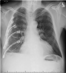 An X-ray of ribs