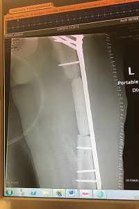 An X-ray shows an image of a bone