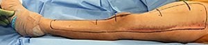 A doctor with markings on a patient's damaged leg