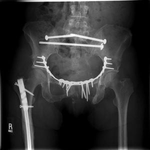 An X-ray shows a patient's badly damaged pelvis.