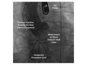 This is an x-ray image from the first patient treated in the low-risk TAVR trial at UCHealth University of Colorado Hospital.