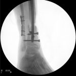 image showing where pins and rods where placed to fix a broken ankle