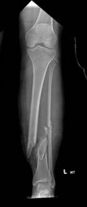 X-ray showing a very broken left leg of a women.