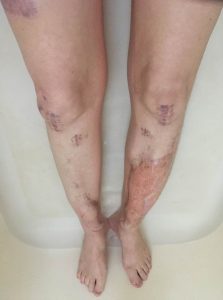 photograph of women's legs that shows multiple scaring and leg graphs.