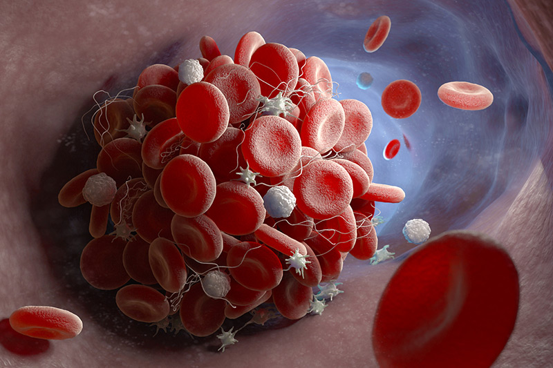 graphic of COVID-19. Autopsies have shown that COVID-19 patients are especially vulnerable to blood clots forming aggressively in the lungs and researchers are trying to determine if the clot buster tPA may help.