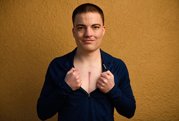 Matt Johnston, who was born with a heat defect, shows off a scar from heart valve surgery.