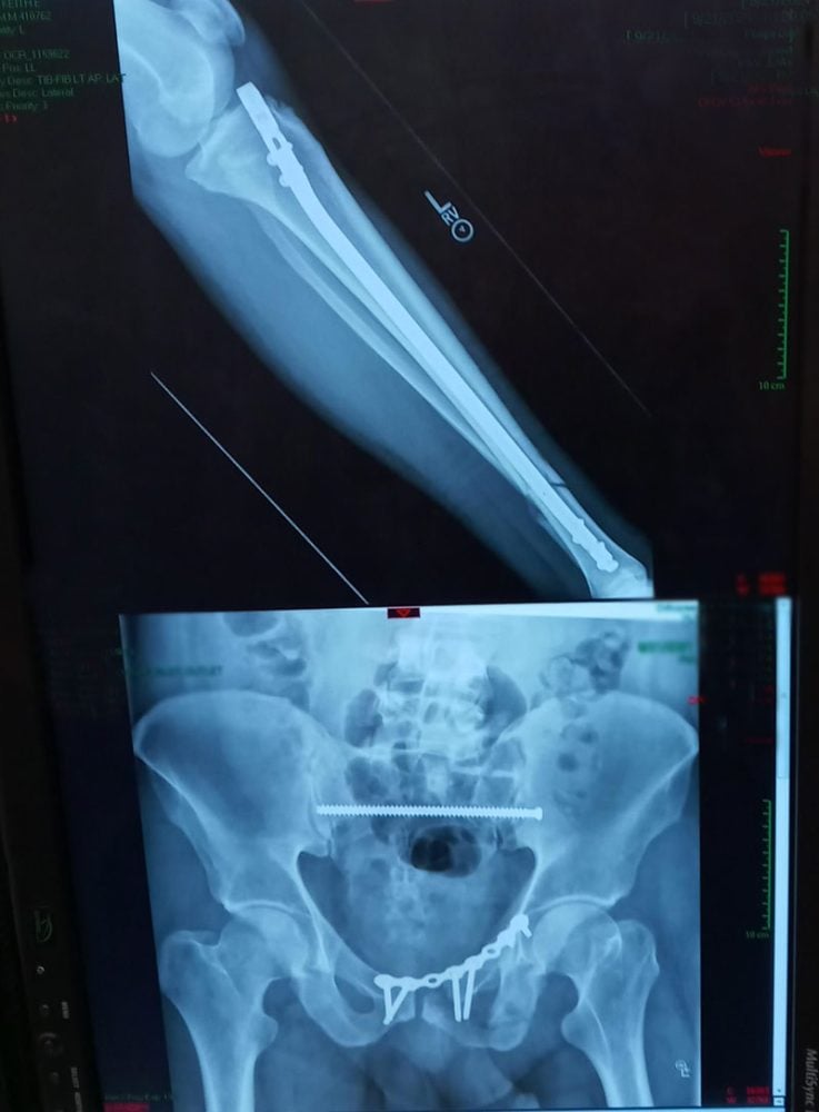 Keith's X-rays show the damage to his leg and pelvis, both repaired through surgeries. Photo courtesy of Keith Thiel.