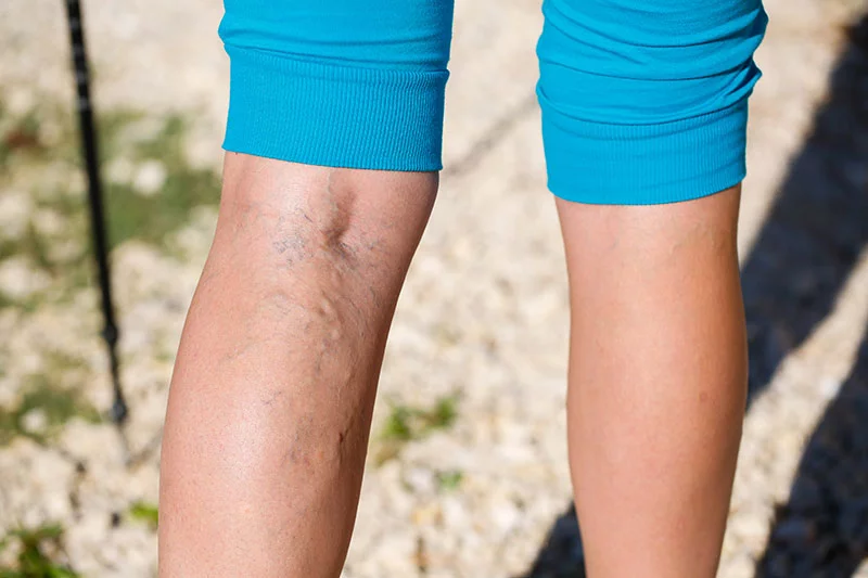 back of legs showing varicose veings. Photo: Getty Images.